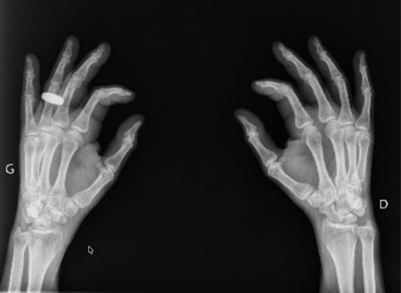 CT scan of hands